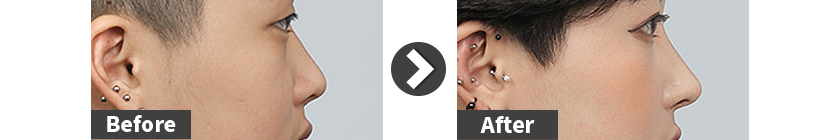 soft-mesh-rhinoplasty