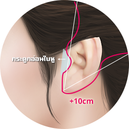 benefits-of-volume-mini-facelift-incision-exposed-by-10cm-or-more