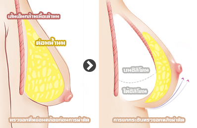breast-lifting-with-dual-plane-method
