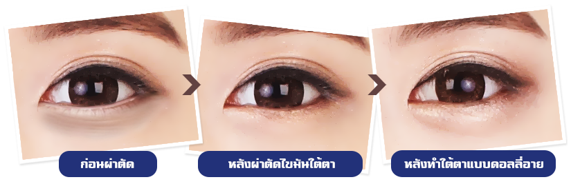 under-eye-fat-re-positioning-love-band