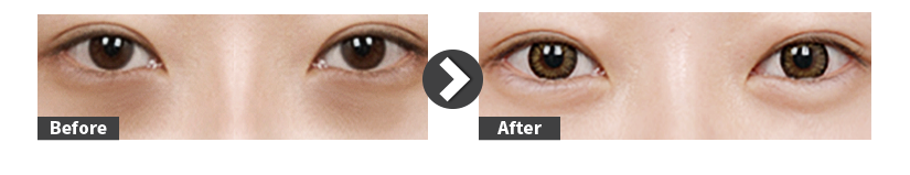 under-eye-fat-re-positioning-before-after