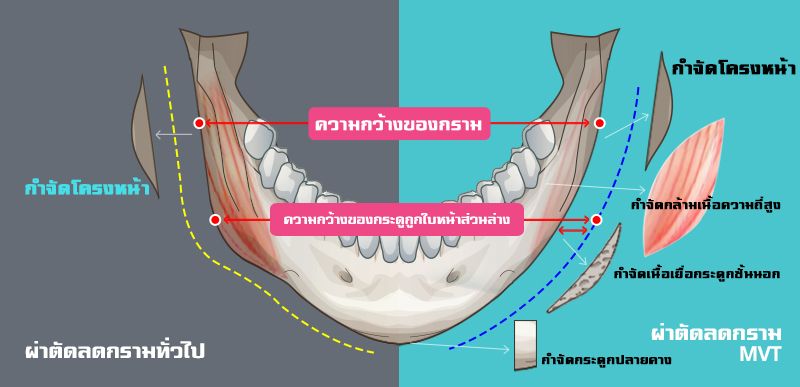 mandible-reduction-general-and-mvt