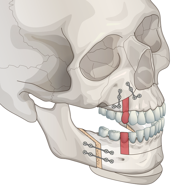 mouth-protrusion-three-jaw-correction-surgery