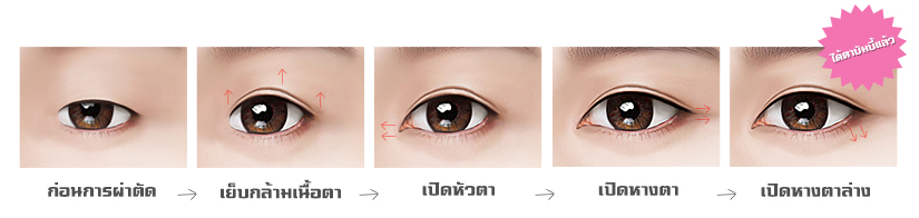 bambi-eye-surgery-sleepy-eyes-transformation-process