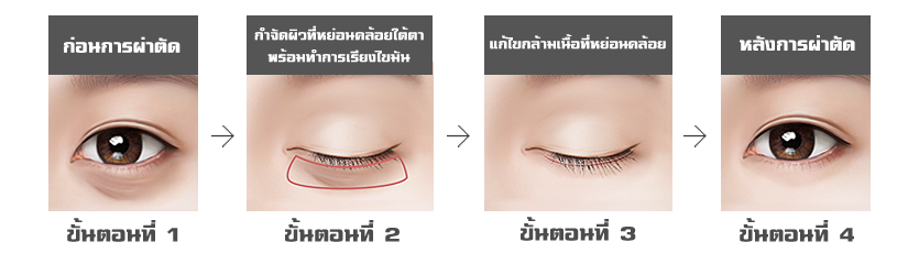 lower-eyelid-ptosis-correction-methods-of-surgery