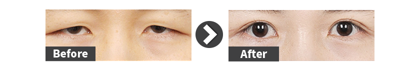 incisional-ptosis-correction-before-after