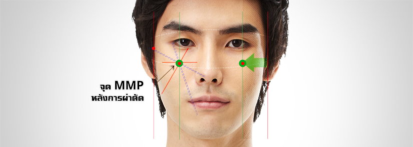 men-facial-width-through-highl-l-cheekbone-reduction