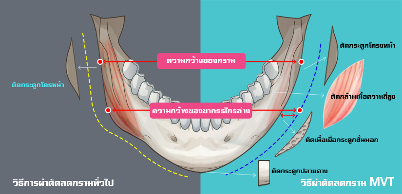 mvt-square-jaw-reduction-slim-v-line