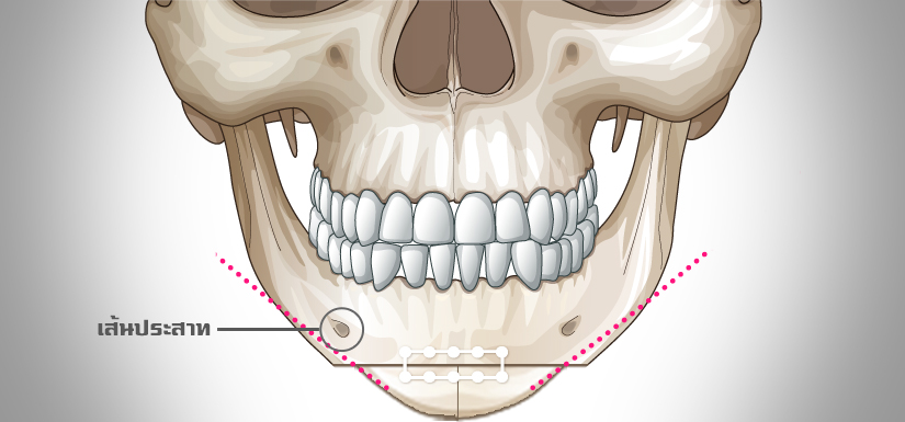 mini-v-line-front-chin-surgery-men