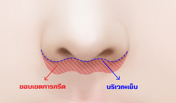 philtrum-reduction-surgery-with-no-scars