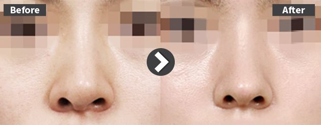 id-revision-rhinoplasty-cases-tilted-nose-implant