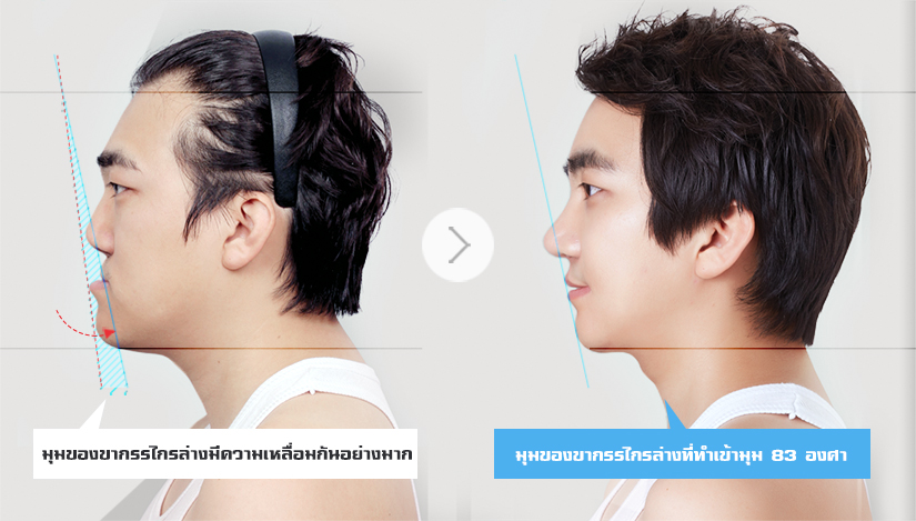 men-orthognathic-surgery-outstanding-cosmetic-effects