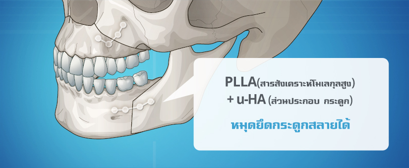 men-orthognathic-surgery-undetectable-two-jaw