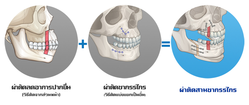 men-orthognathic-surgery-mouth-protrusion-three-jaw