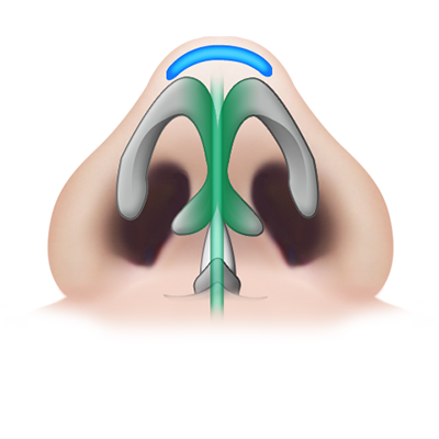 soft-mesh-rhinoplasty-one-year-after-surgery