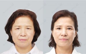 non-incision-ptosis-correction-before-and-after-photo-model2-front