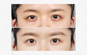 under-eye-fat-re-positioning-before-and-after-model2-picture-zoom