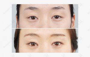 revision-eyelid-surgery-beforeafter-model2-picture-zoom
