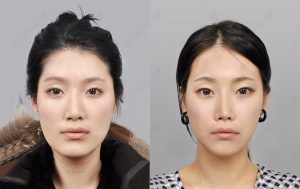 surgery-first-approach-orthognathic-surgery-beforeafter-pictures-model4-front