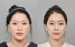 orthognathic-surgery-before-and-after-model1-front