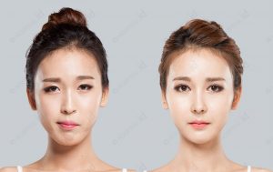 orthognathic-surgery-before-and-after-photograph-model3-front