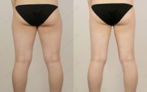 id-liposuction-beforeandafter-model29-photo-back-zoom