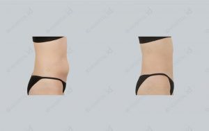 id-liposuction-before-and-after-model5-photograph-front