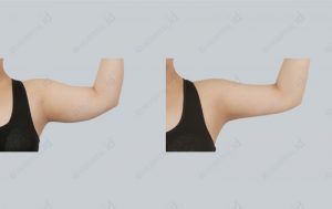 id-liposuction-before-and-after-model9-photograph-front