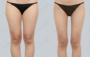 id-liposuction-beforeandafter-model25-photo-front