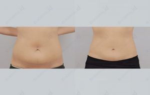id-tummy-tuck-beforeafter-model4-front-pictures