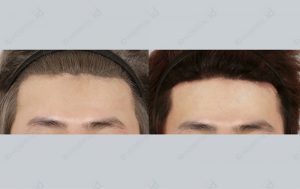 id-hairline-forehead-reduction-beforeandafter-photo