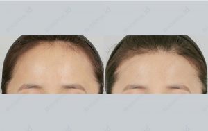 id-hairline-forehead-reduction-beforeafter-wamenmodel-phtograph