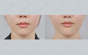 midface-philtrum-reduction-surgery-model2-beforeandafter-photos