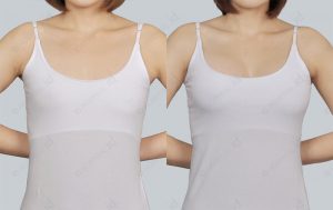 y-line-breast-surgery-beforeafter-model2-photos-front