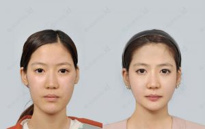 orthognathic-surgery-before-and-after-pictures-model6-front