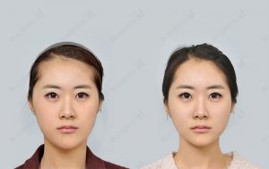 orthognathic-surgery-beforenafter-photograph-model5-front