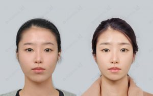 no-tie-double-jaw-surgery-beforeafter-photographs-model3-front
