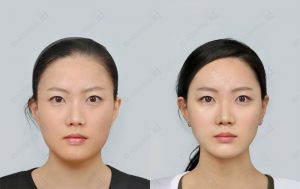 mandibular-surgery-before-and-after-photos-model2-front