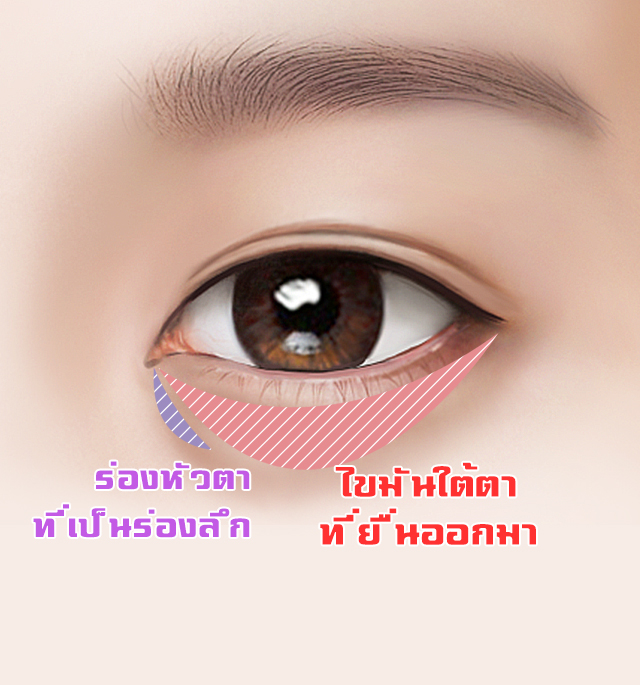 id-hospital-lower-blepharoplasty-reposition-of-fat-under-mid-age-eyes