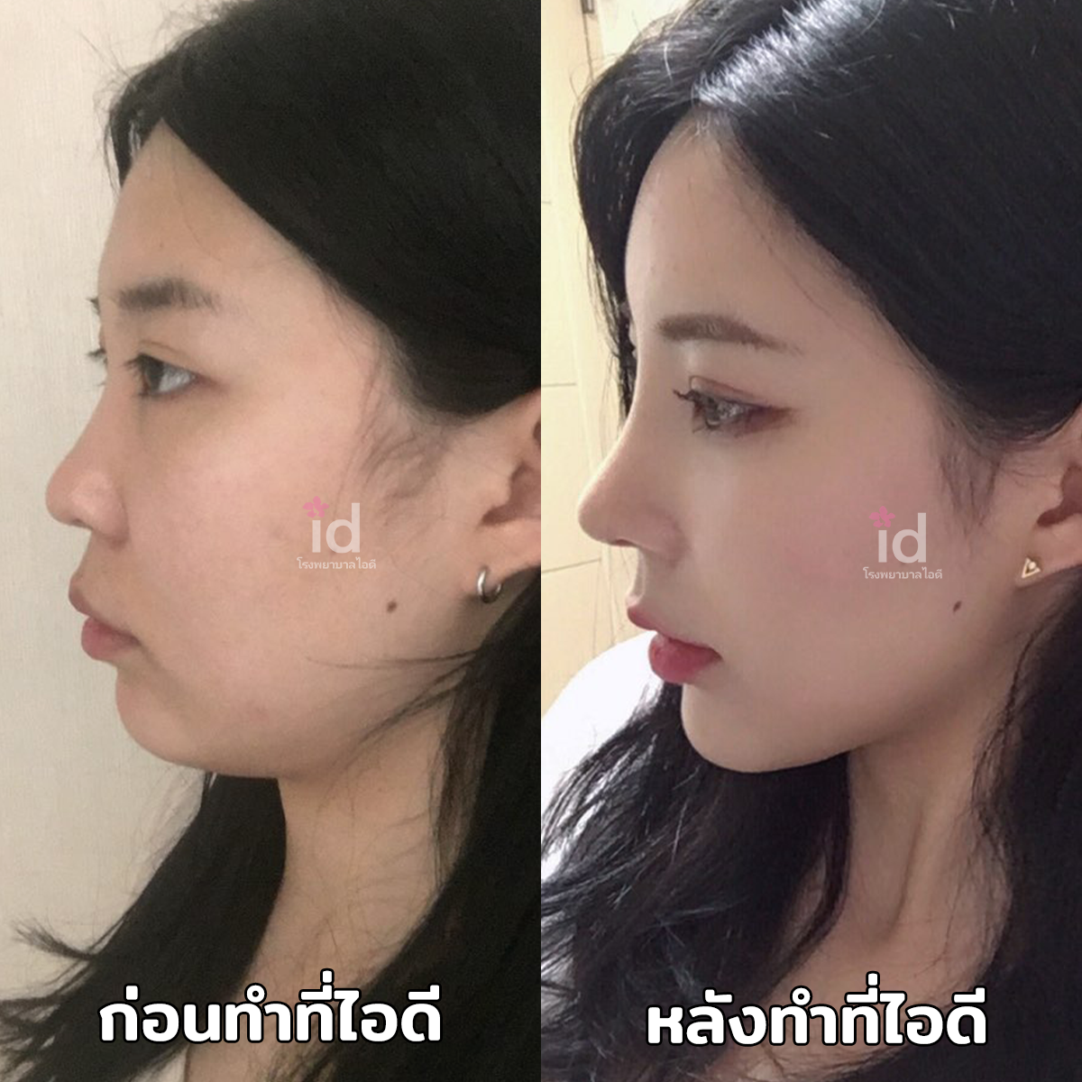 ภาพรีวิวก่อนและหลังจมูก เคสที่ 18037