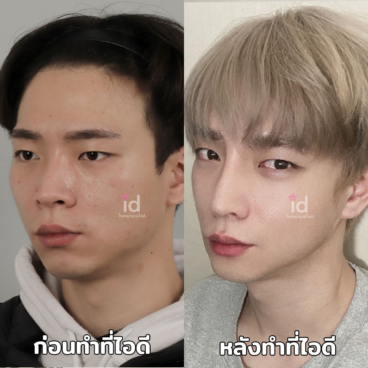 ภาพรีวิวก่อนและหลังศัลยกรรมโครงหน้า เคสที่ 18041