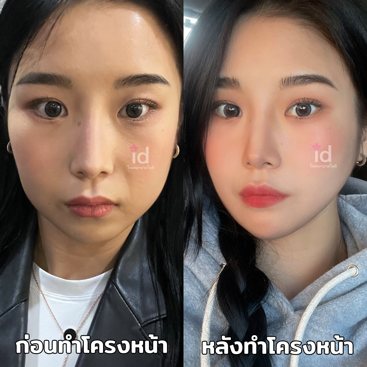 ภาพรีวิวก่อนและหลังศัลยกรรมโครงหน้า เคสที่ 18085