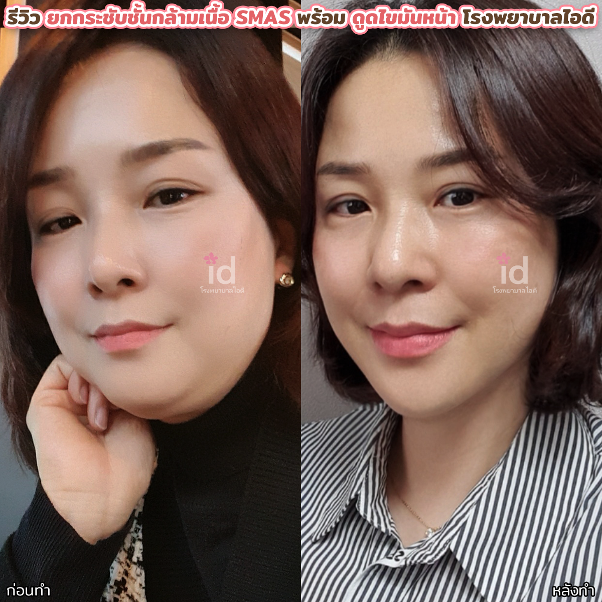 ภาพรีวิวก่อนและหลังชะลอวัย เคสที่ 18087