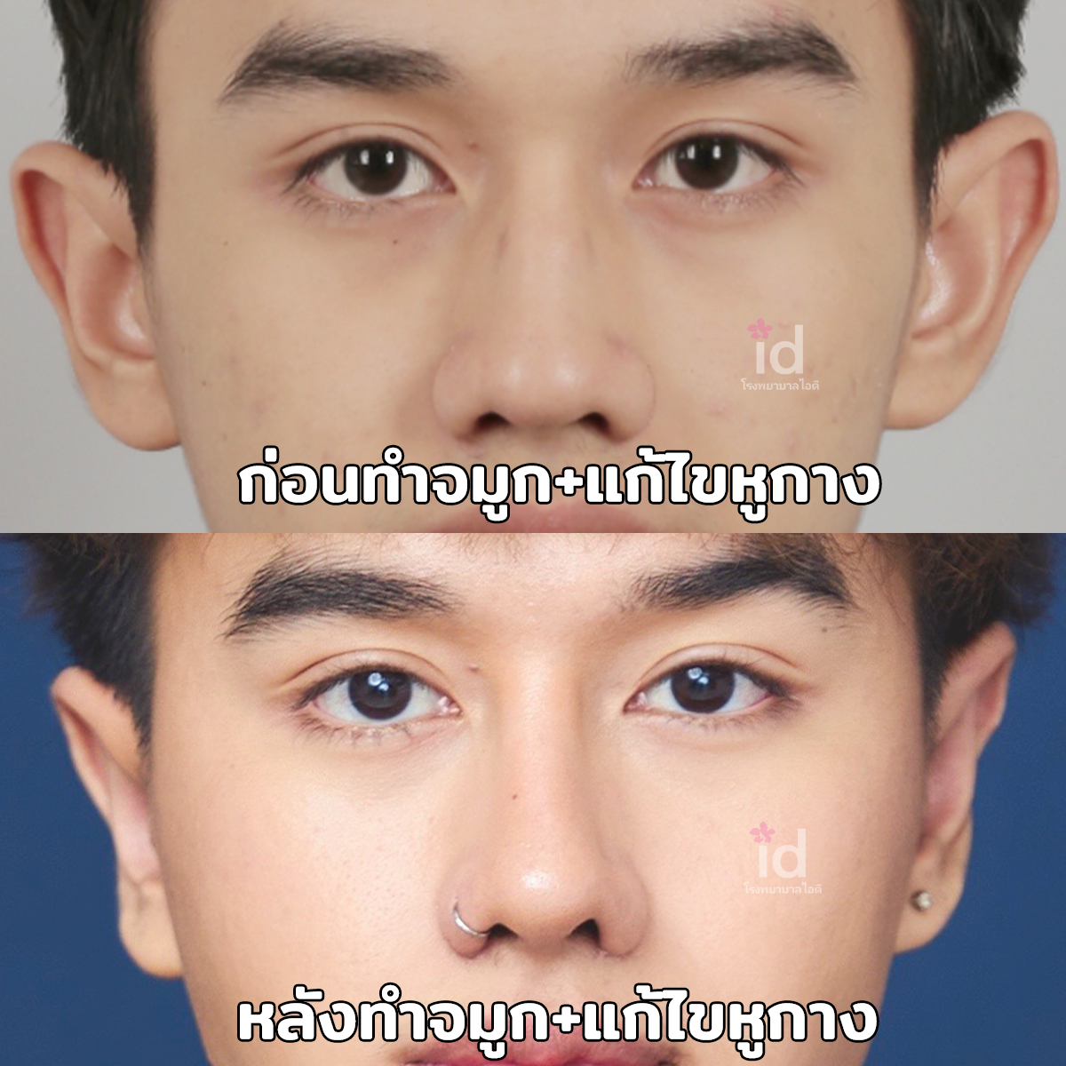 ภาพรีวิวก่อนและหลังจมูก เคสที่ 18089