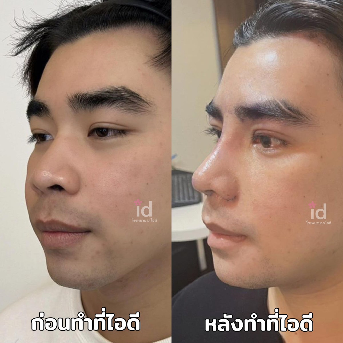 ภาพรีวิวก่อนและหลังศัลยกรรมโครงหน้า เคสที่ 18096