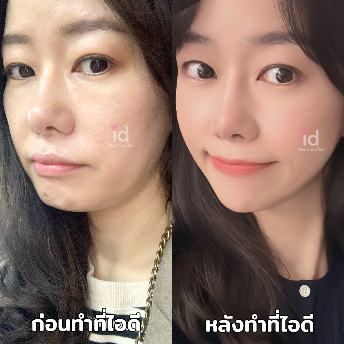 ภาพรีวิวก่อนและหลังชะลอวัย เคสที่ 18145
