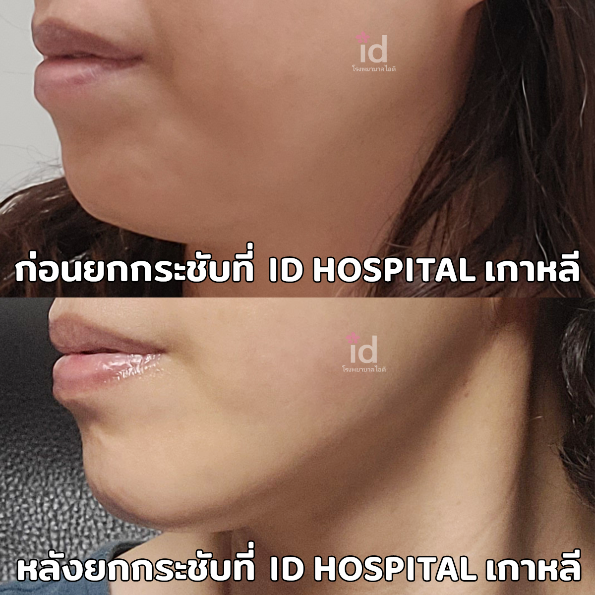 ภาพรีวิวก่อนและหลังชะลอวัย เคสที่ 18141