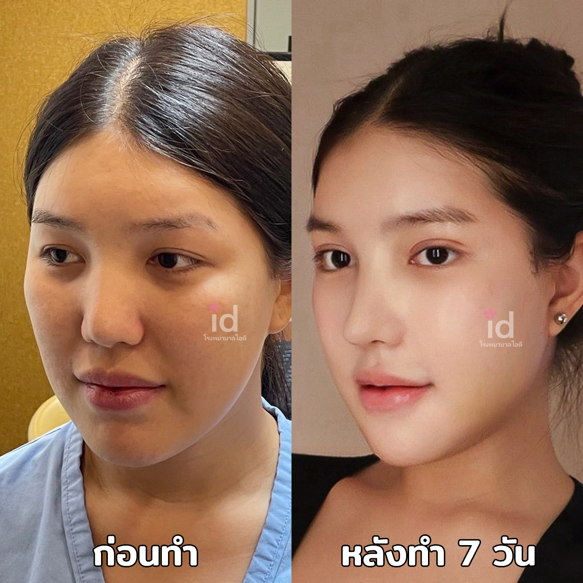 ภาพรีวิวก่อนและหลังศัลยกรรมโครงหน้า เคสที่ 18127
