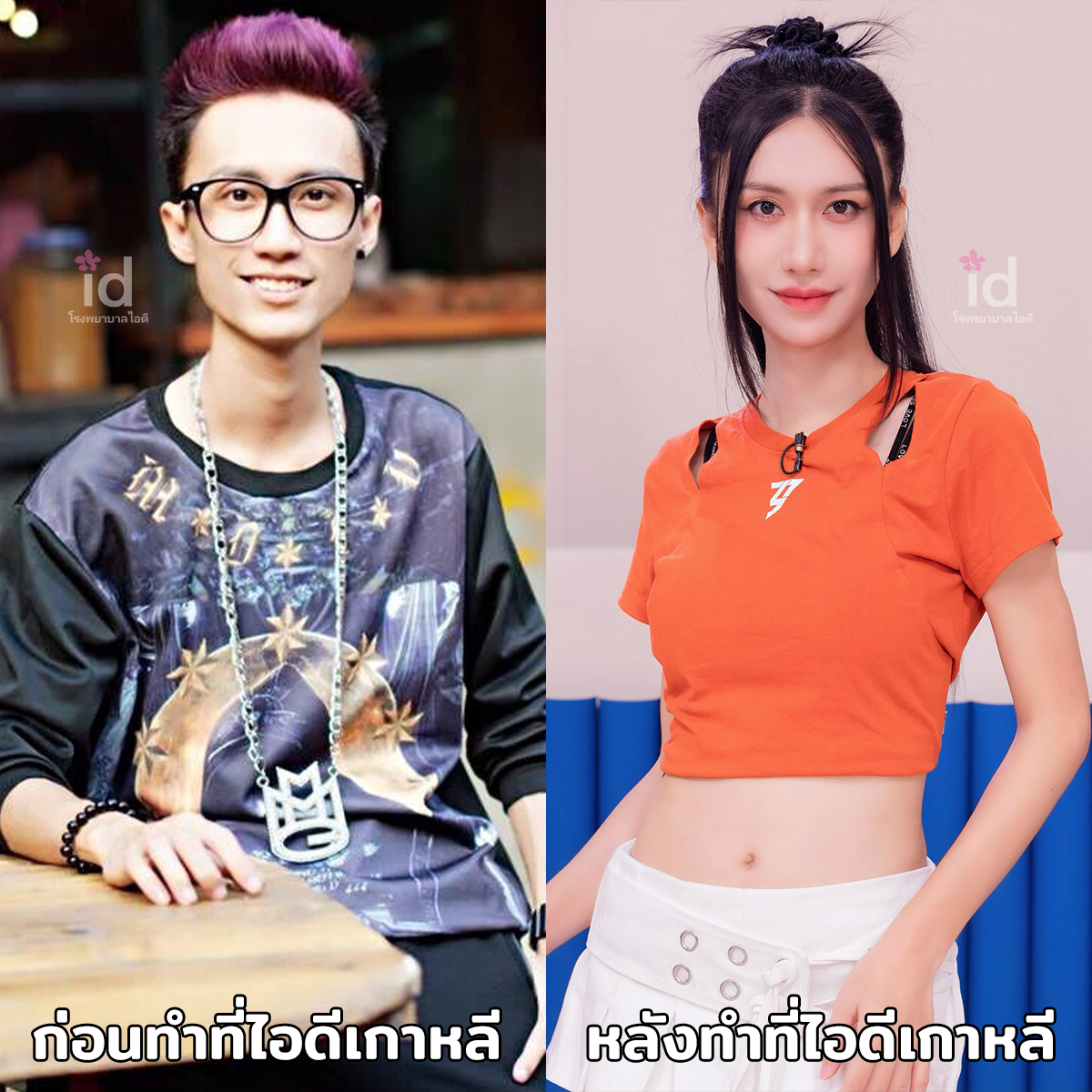 ภาพรีวิวก่อนและหลังศัลยกรรมโครงหน้า เคสที่ 18225
