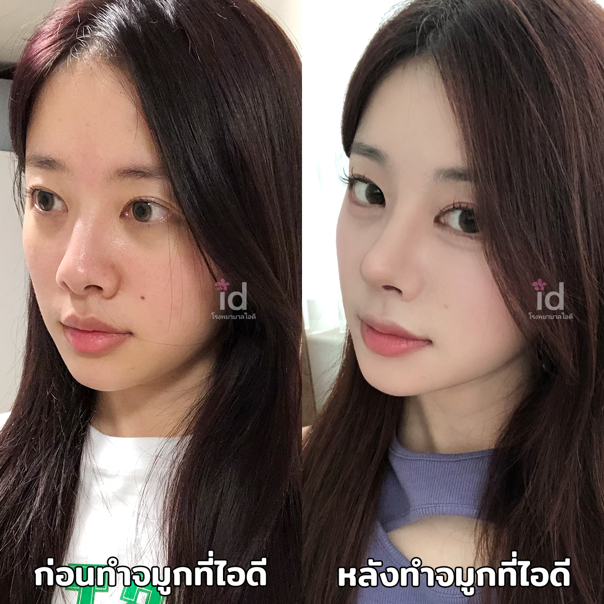 ภาพรีวิวก่อนและหลังจมูก เคสที่ 18229